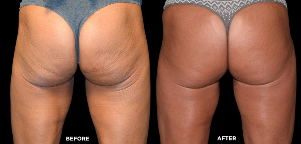 Non-Surgical Butt Lifts Are the New Plastic Surgery Trend for 2017