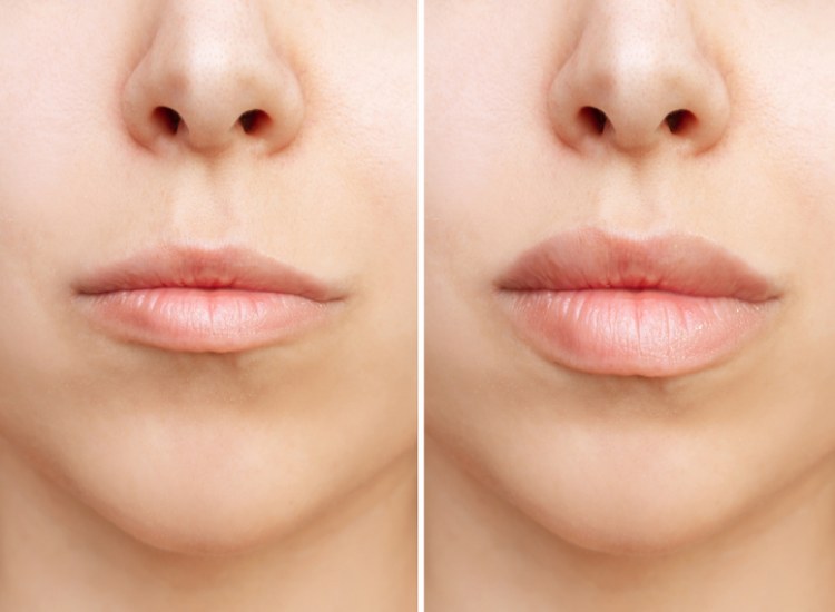 Before & After Lip Fillers in Fairfield, CT