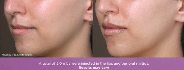 Juvéderm Volbella® Lip Injection Results in Fairfield CT