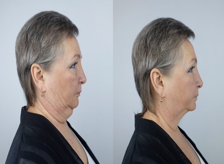 Before & After Instalift Thread Lift Procedures in Fairfield, CT