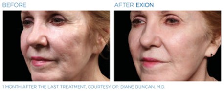 Before and After Image of Exion Fractional RF Treatment by BTL in Fairfield, CT