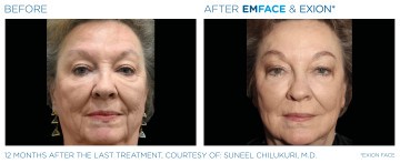 Before & After Image of Exion Fractional RF Treatment in Fairfield, CT by All About You Medical Spa