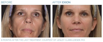 Before and After Image of Exion RF Face Sculpting Treatment in Fairfield, CT