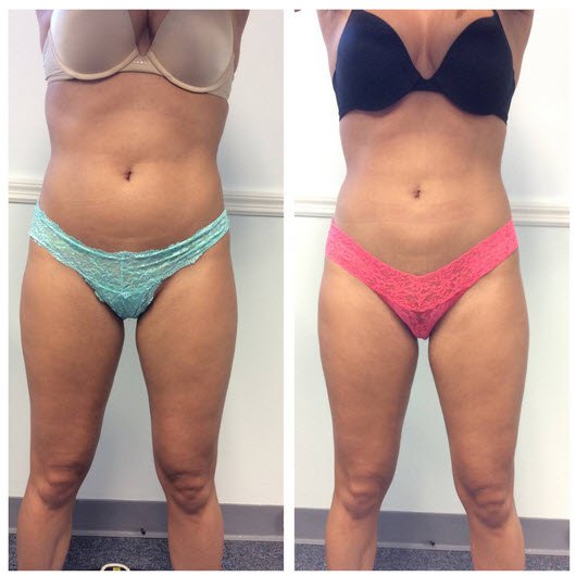 CoolSculpting Lower Abdomen Transformation, Treating your lower abdomen  with CoolSculpting is a quick treatment with incredible results.…
