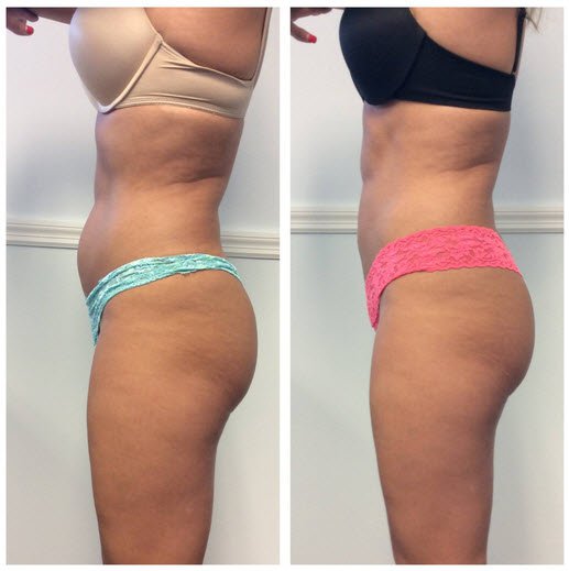 Non-Invasive Fat Removal: An Honest Review on CoolSculpting® & truSculpt  iD® From Someone Who Had Both Body-Sculpting Procedures, Procedures